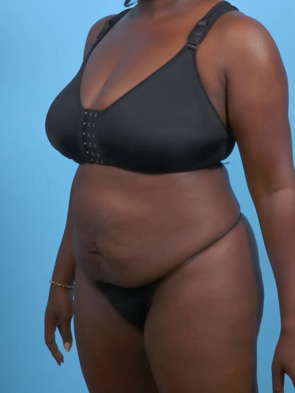 Tummy Tuck Patient Photo - Case 29474 - before view-1