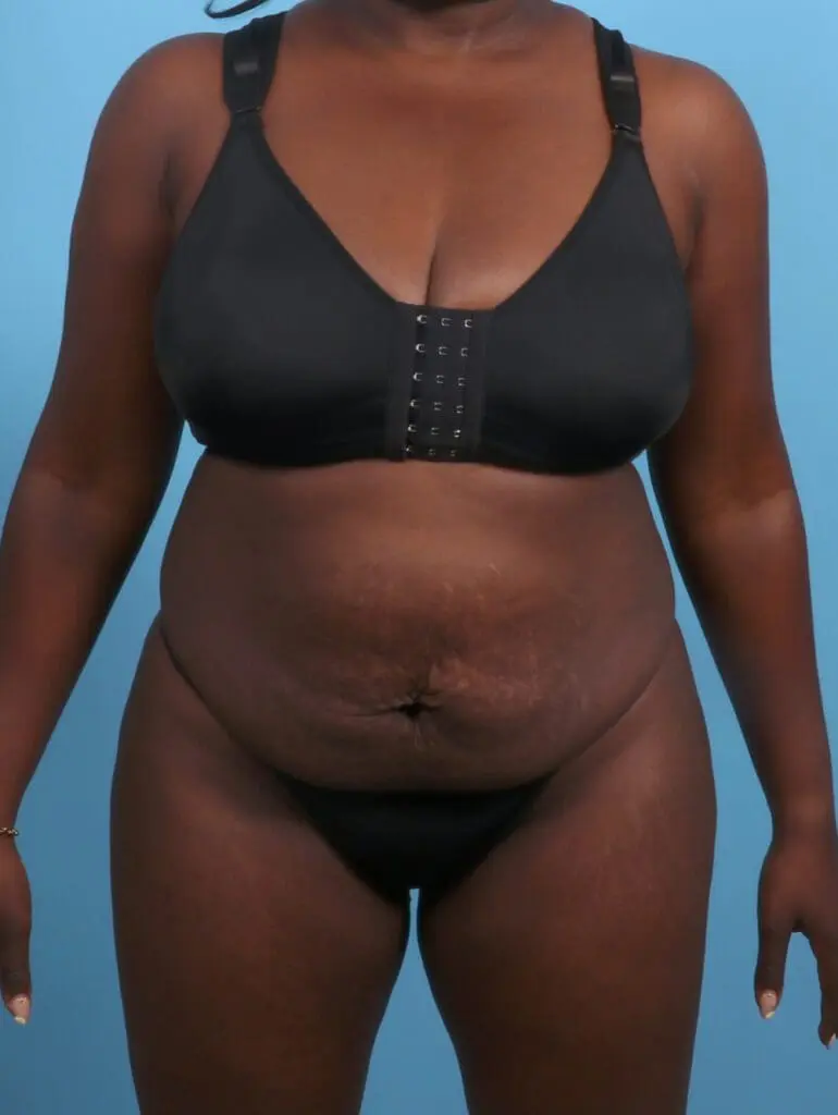 Tummy Tuck - Case 29474 - Before