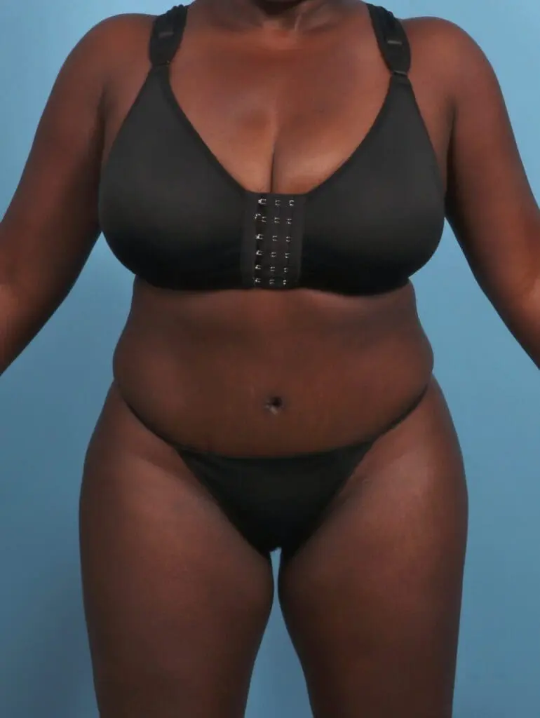 Tummy Tuck - Case 29474 - After