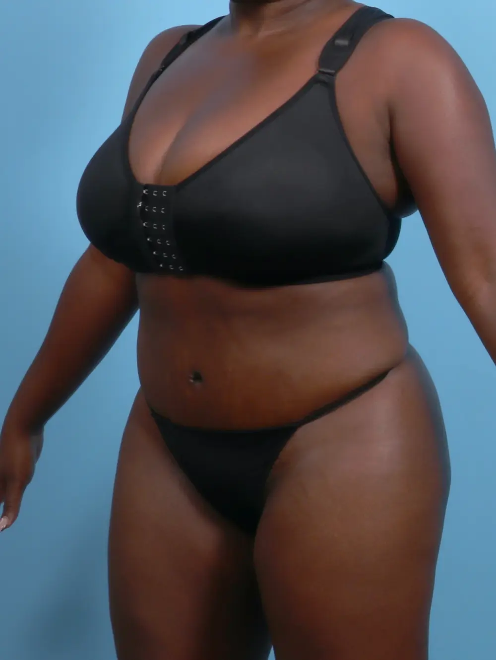 Tummy Tuck Patient Photo - Case 29474 - after view-1