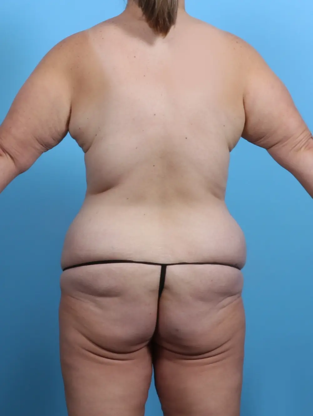 Body Lift Patient Photo - Case 29484 - before view-3
