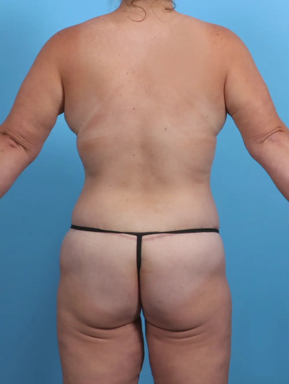 Body Lift Patient Photo - Case 29484 - after view-3