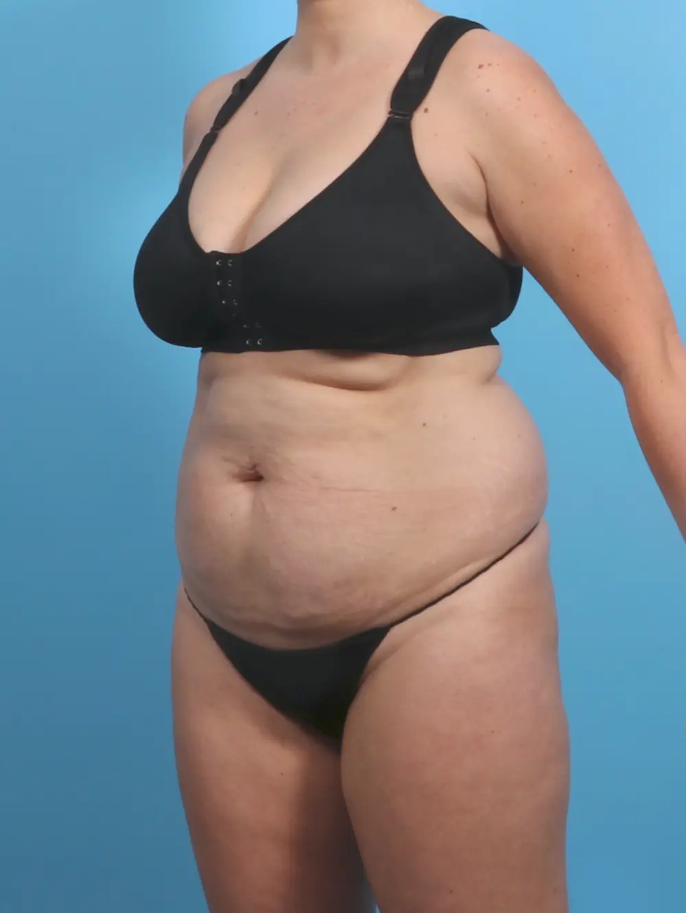 Tummy Tuck Patient Photo - Case 29494 - before view-1