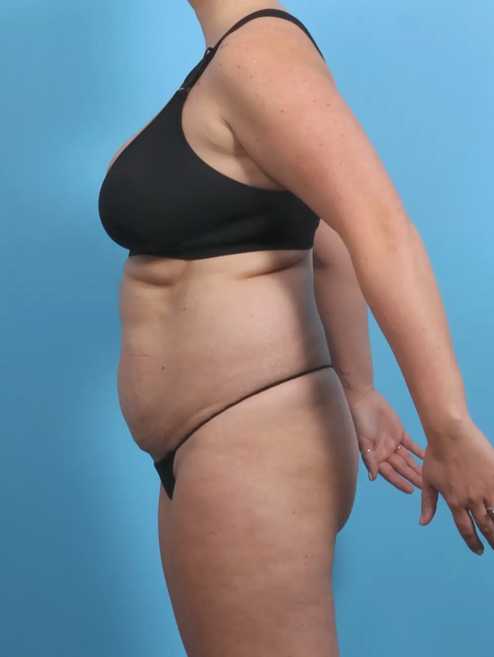 Tummy Tuck Patient Photo - Case 29494 - before view-2