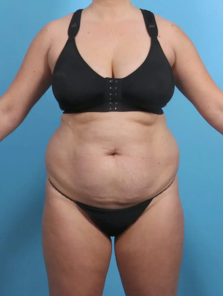 Tummy Tuck - Case 29494 - Before