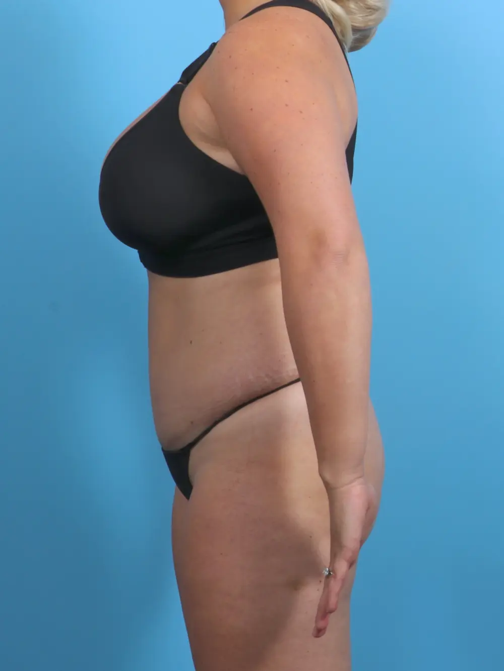 Tummy Tuck Patient Photo - Case 29494 - after view-2