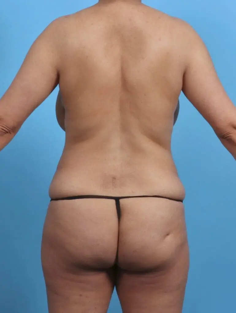 Brazilian Butt Lift - Case 29525 - Before
