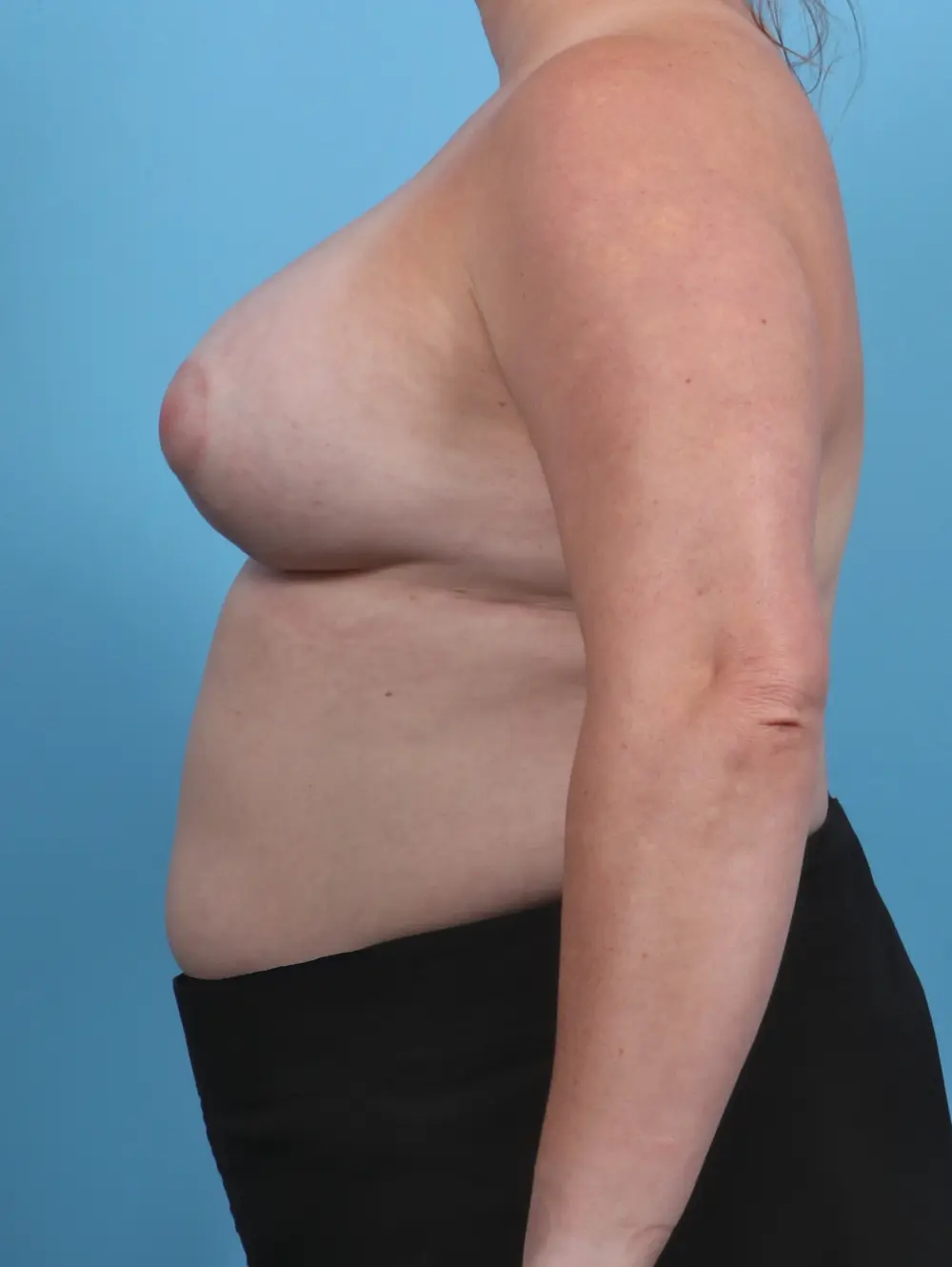 Breast Implant Revision Patient Photo - Case 29545 - after view-2