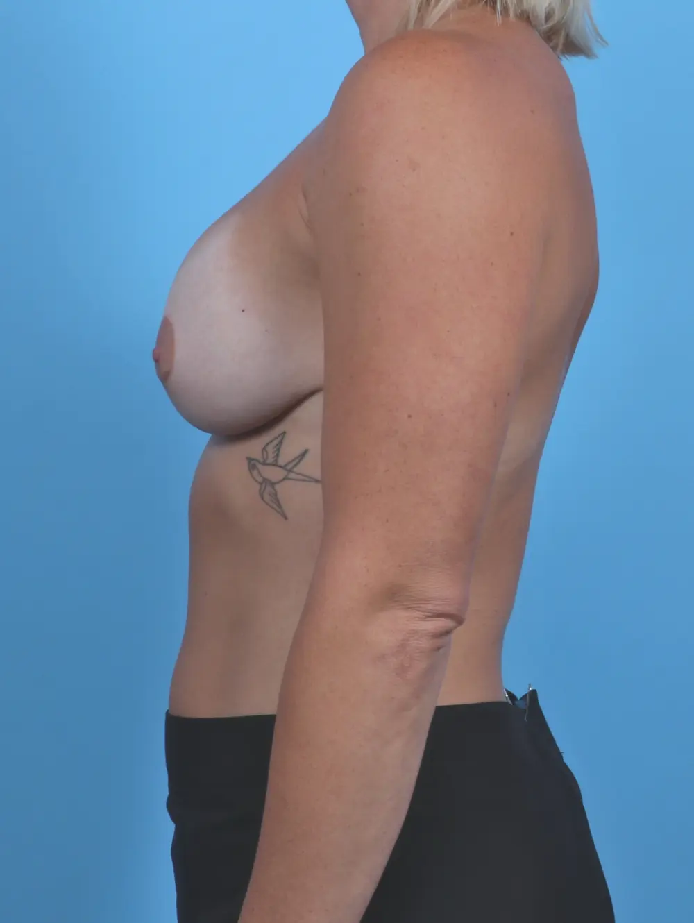 Breast Lift/Reduction with Implants Patient Photo - Case 29553 - after view-2