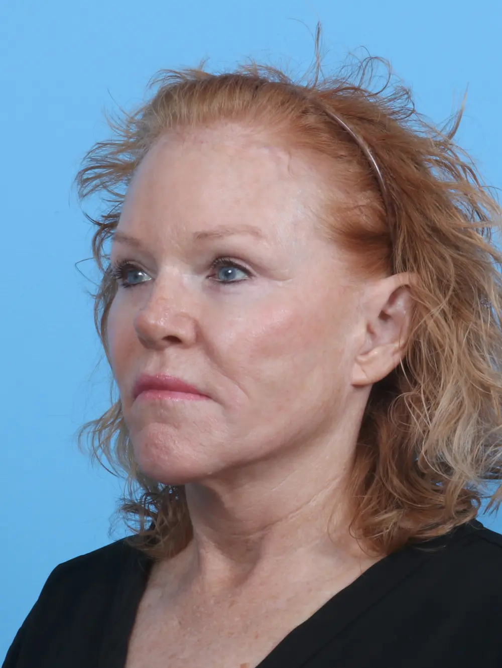 Brow Lift Patient Photo - Case 29561 - after view-1