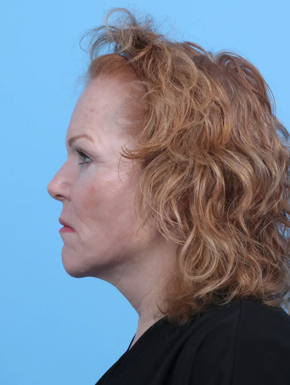 Brow Lift Patient Photo - Case 29561 - before view-2