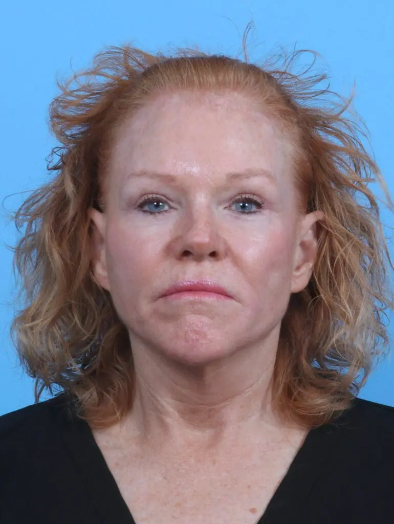 Brow Lift - Case 29561 - After