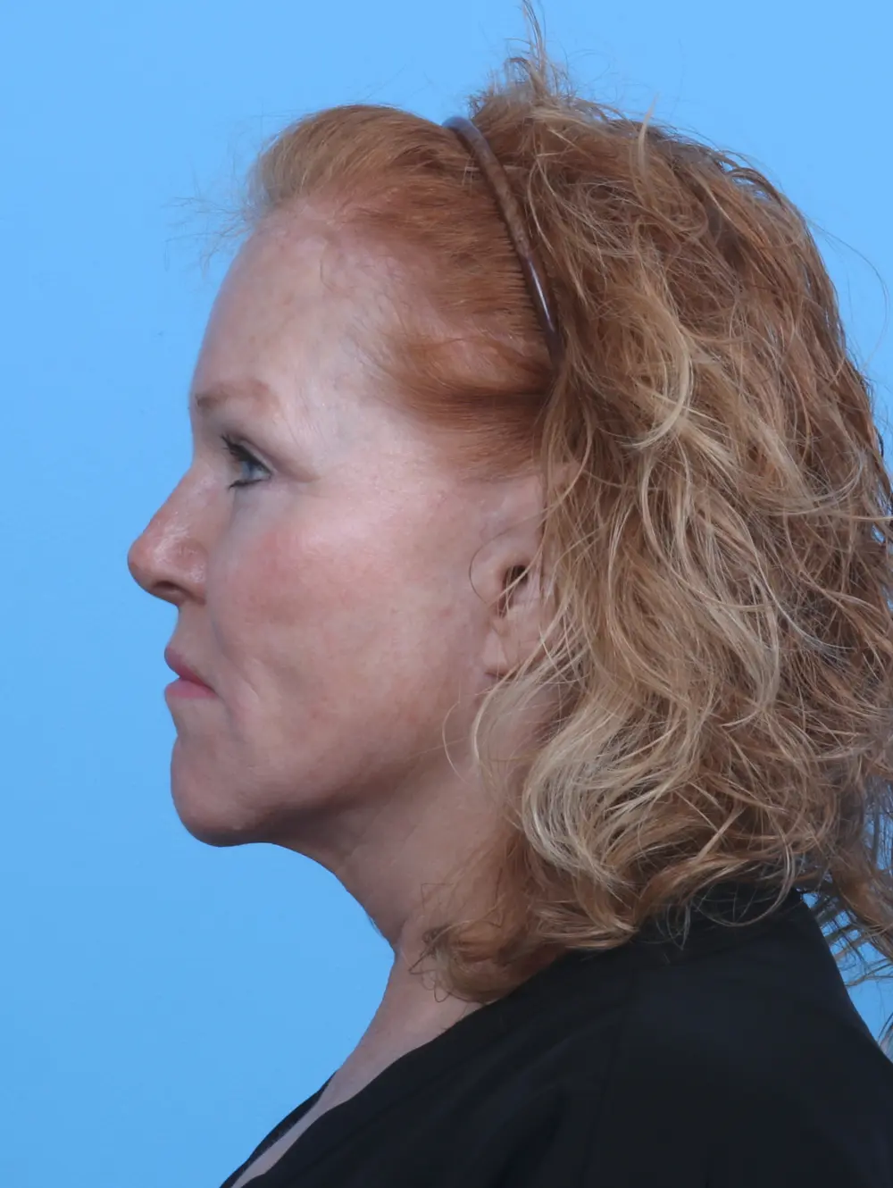 Brow Lift Patient Photo - Case 29561 - after view-2