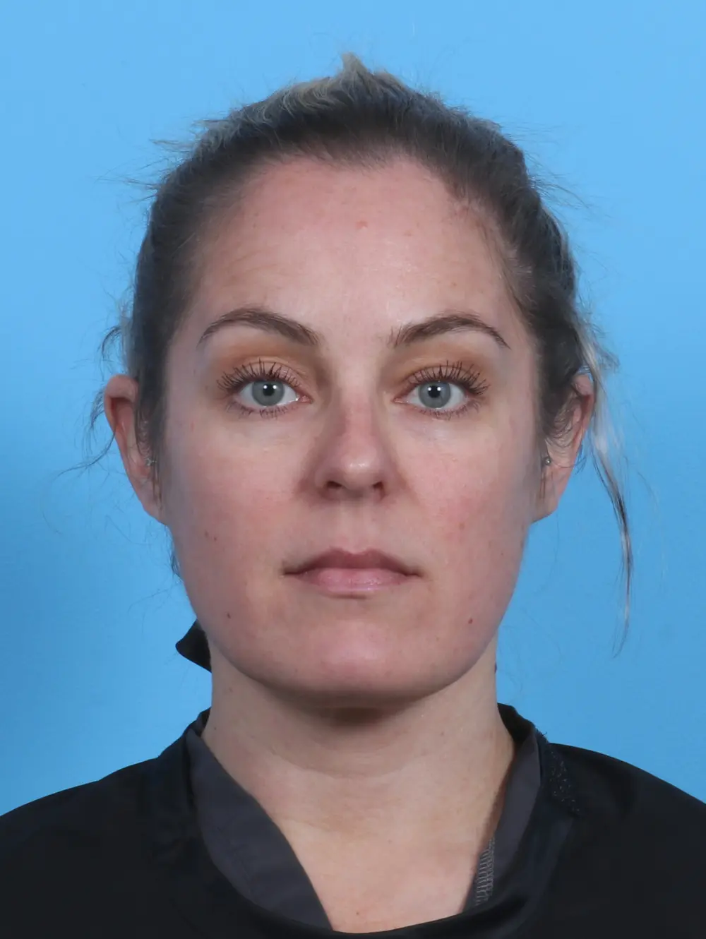 Liposuction Patient Photo - Case 29575 - after view-2