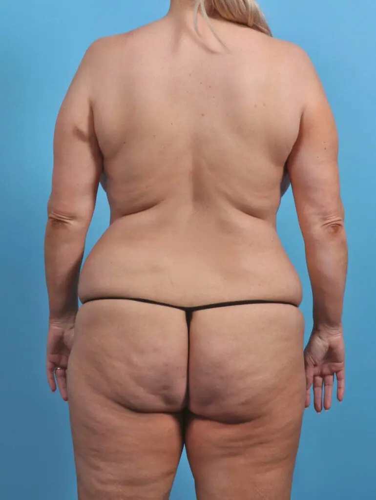 Brazilian Butt Lift - Case 29623 - Before