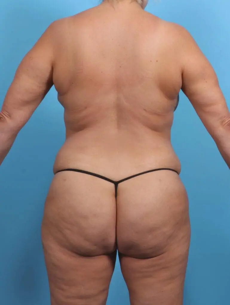 Brazilian Butt Lift - Case 29623 - After