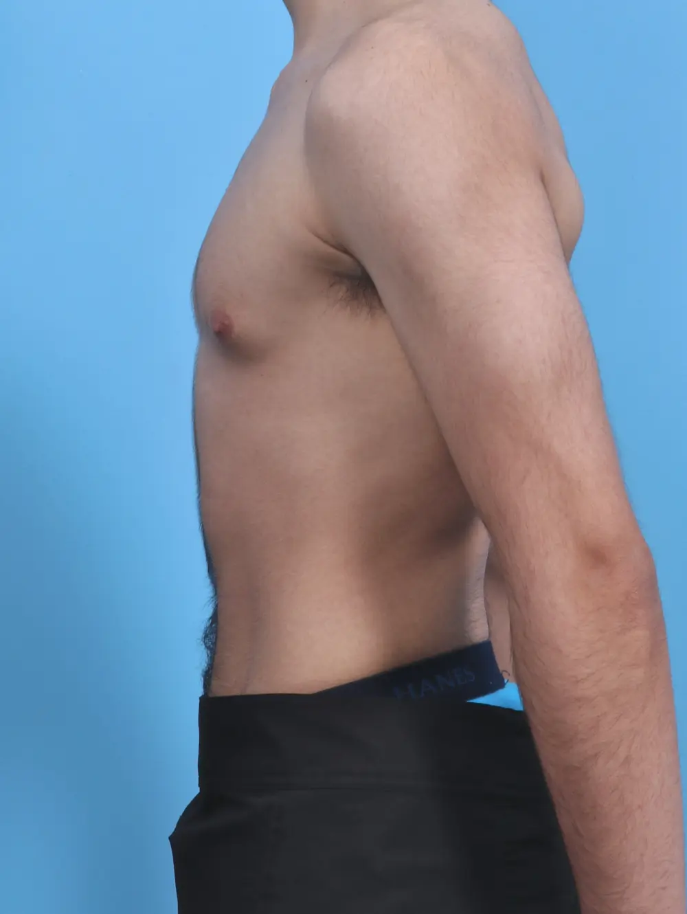 Gynecomastia Patient Photo - Case 29635 - before view-2