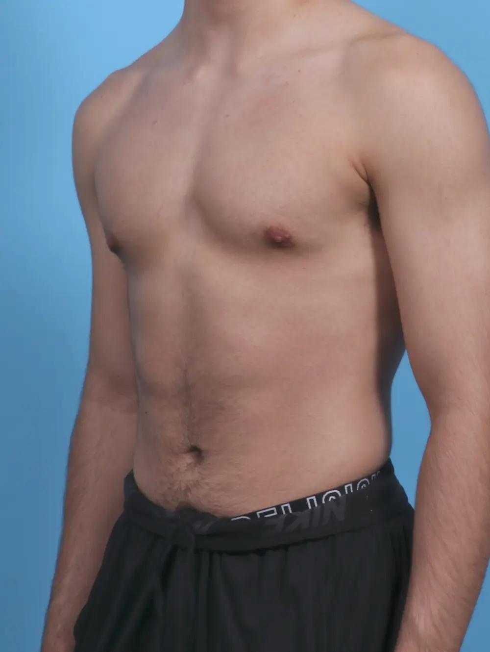 Gynecomastia Patient Photo - Case 29635 - after view-1