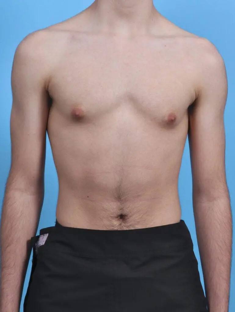 Gynecomastia - Case 29635 - Before