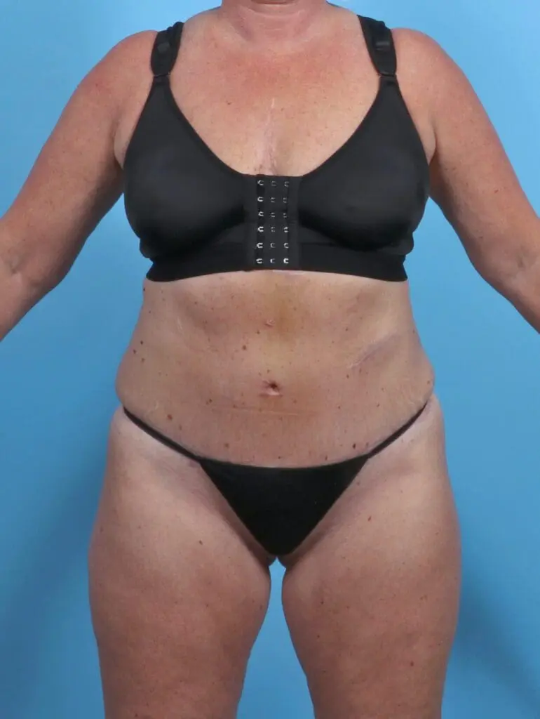 Tummy Tuck - Case 29643 - After