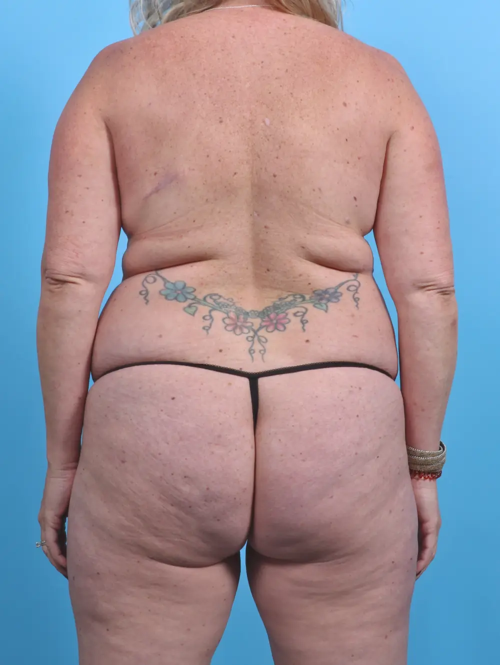 Tummy Tuck Patient Photo - Case 29643 - before view-3