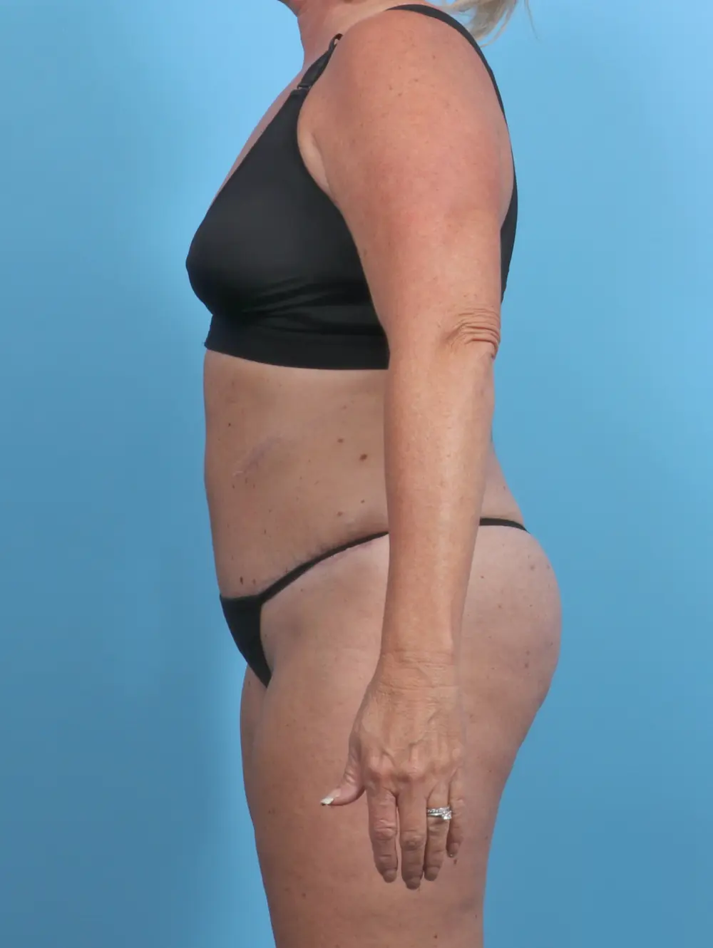 Tummy Tuck Patient Photo - Case 29643 - after view-2