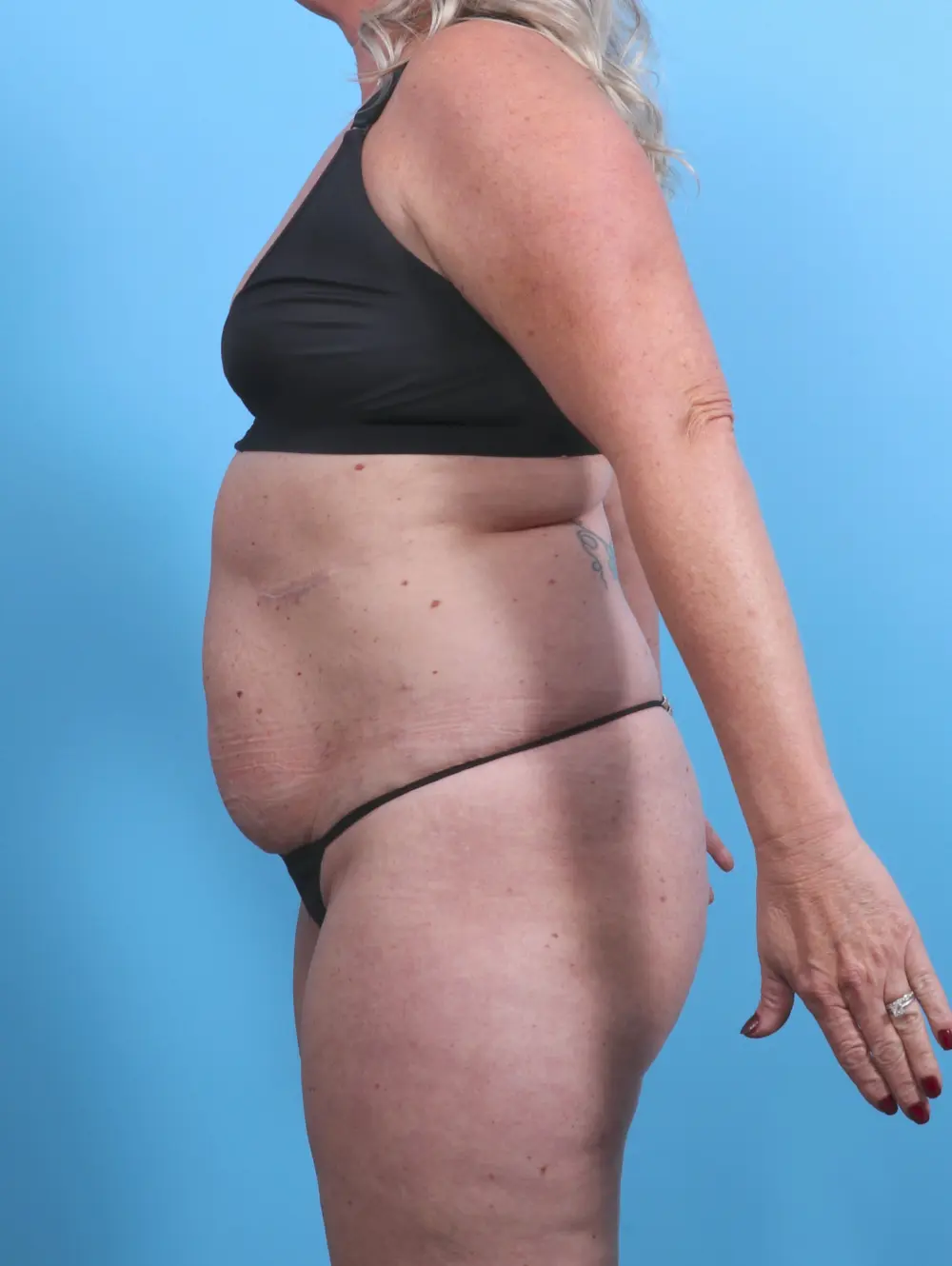 Tummy Tuck Patient Photo - Case 29643 - before view-2