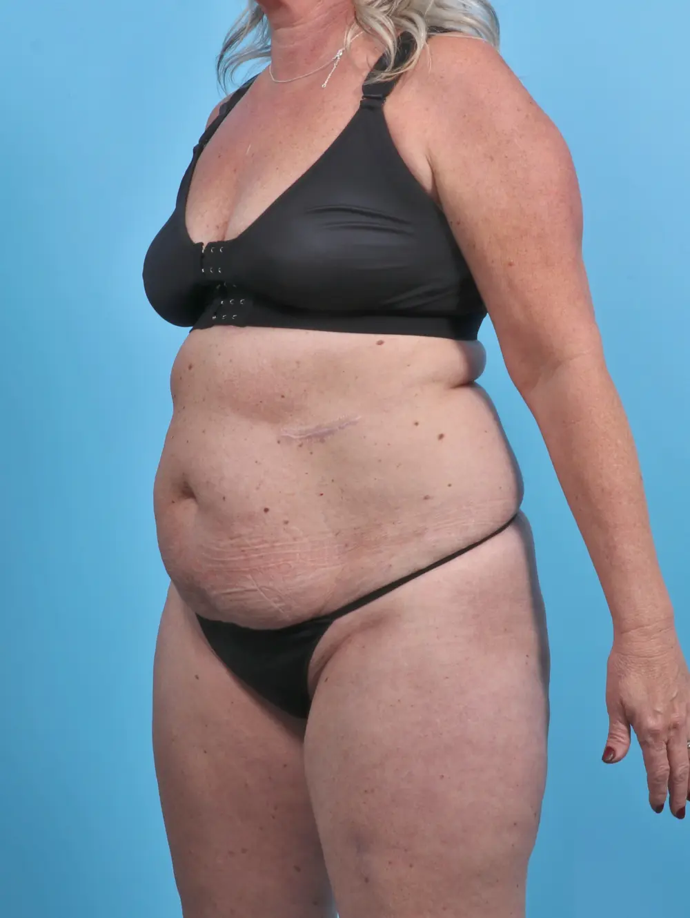 Tummy Tuck Patient Photo - Case 29643 - before view-1