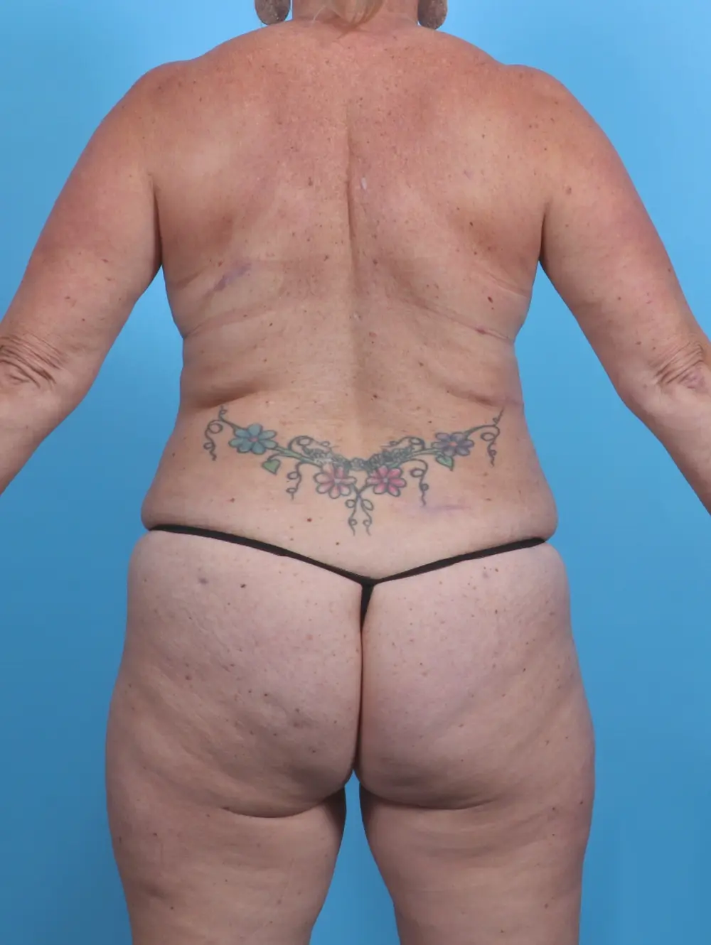 Tummy Tuck Patient Photo - Case 29643 - after view-3