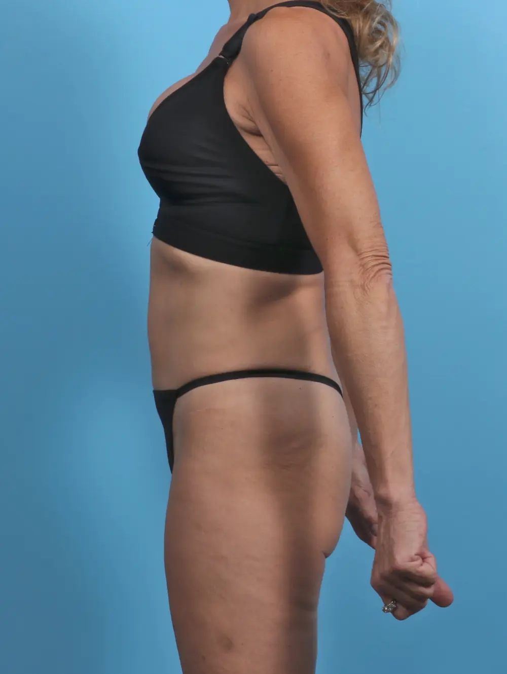 Tummy Tuck Patient Photo - Case 29663 - after view-2