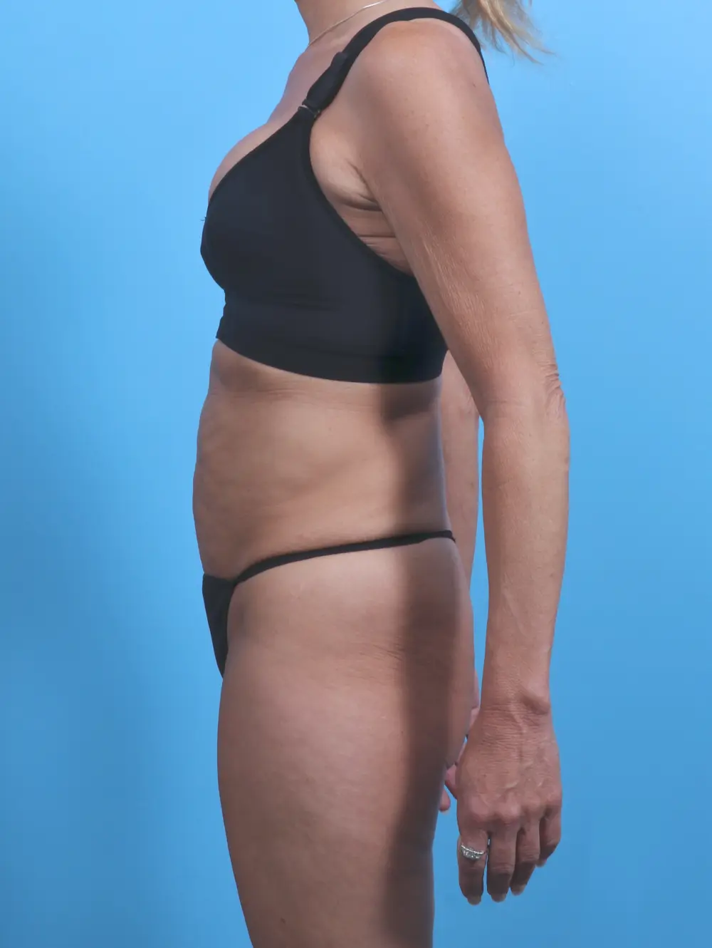 Tummy Tuck Patient Photo - Case 29663 - before view-2