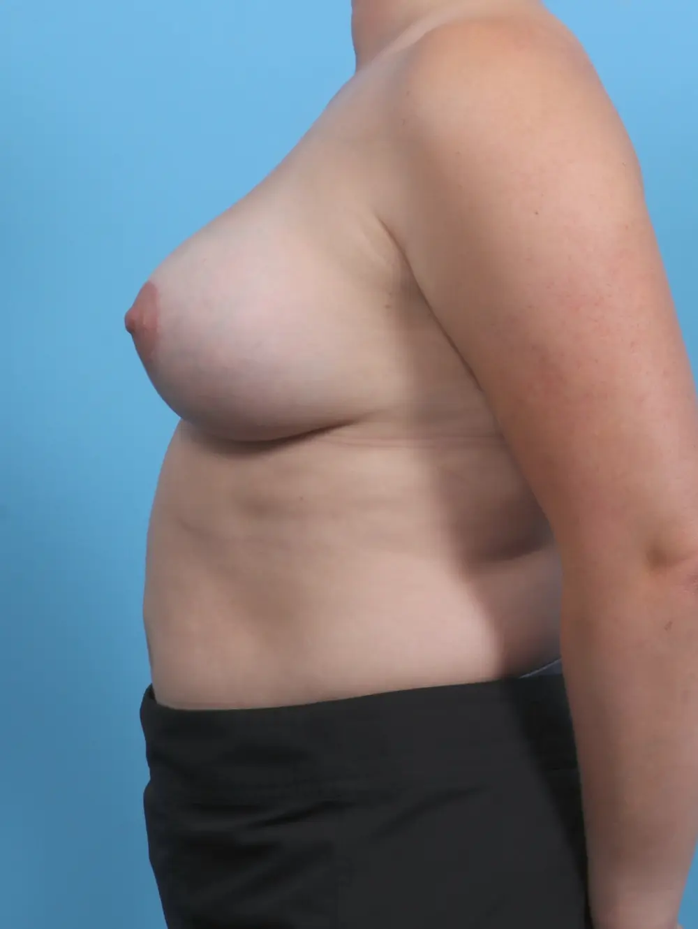 Breast Lift/Reduction with Implants Patient Photo - Case 29689 - after view-2