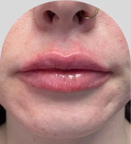 Lip Fillers - Case 29723 - After