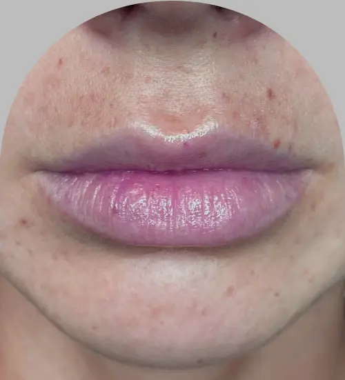 Lip Fillers - Case 29727 - Before