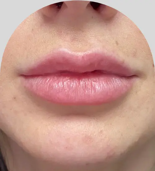 Lip Fillers - Case 29727 - After
