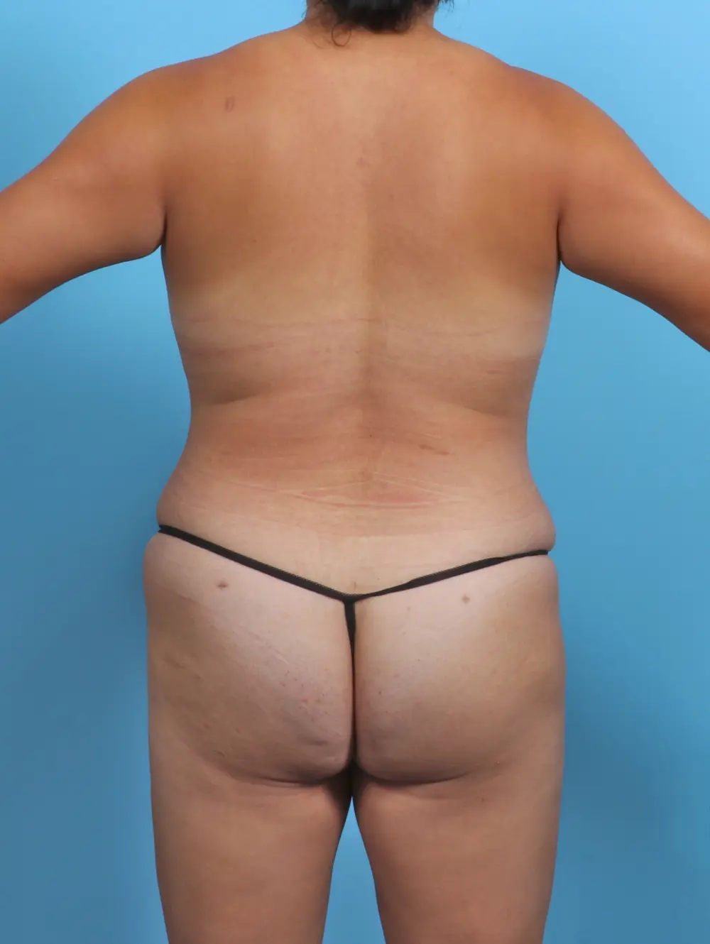 After Liposuction