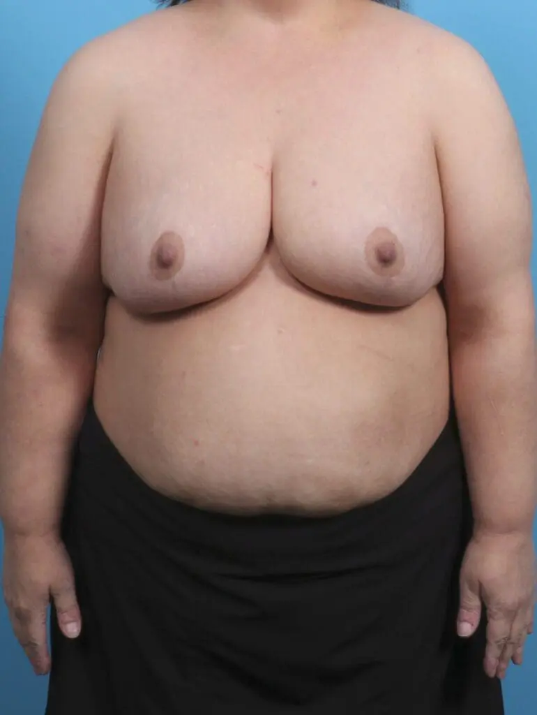 Breast Lift/Reduction w/o Implants - Case 29745 - After