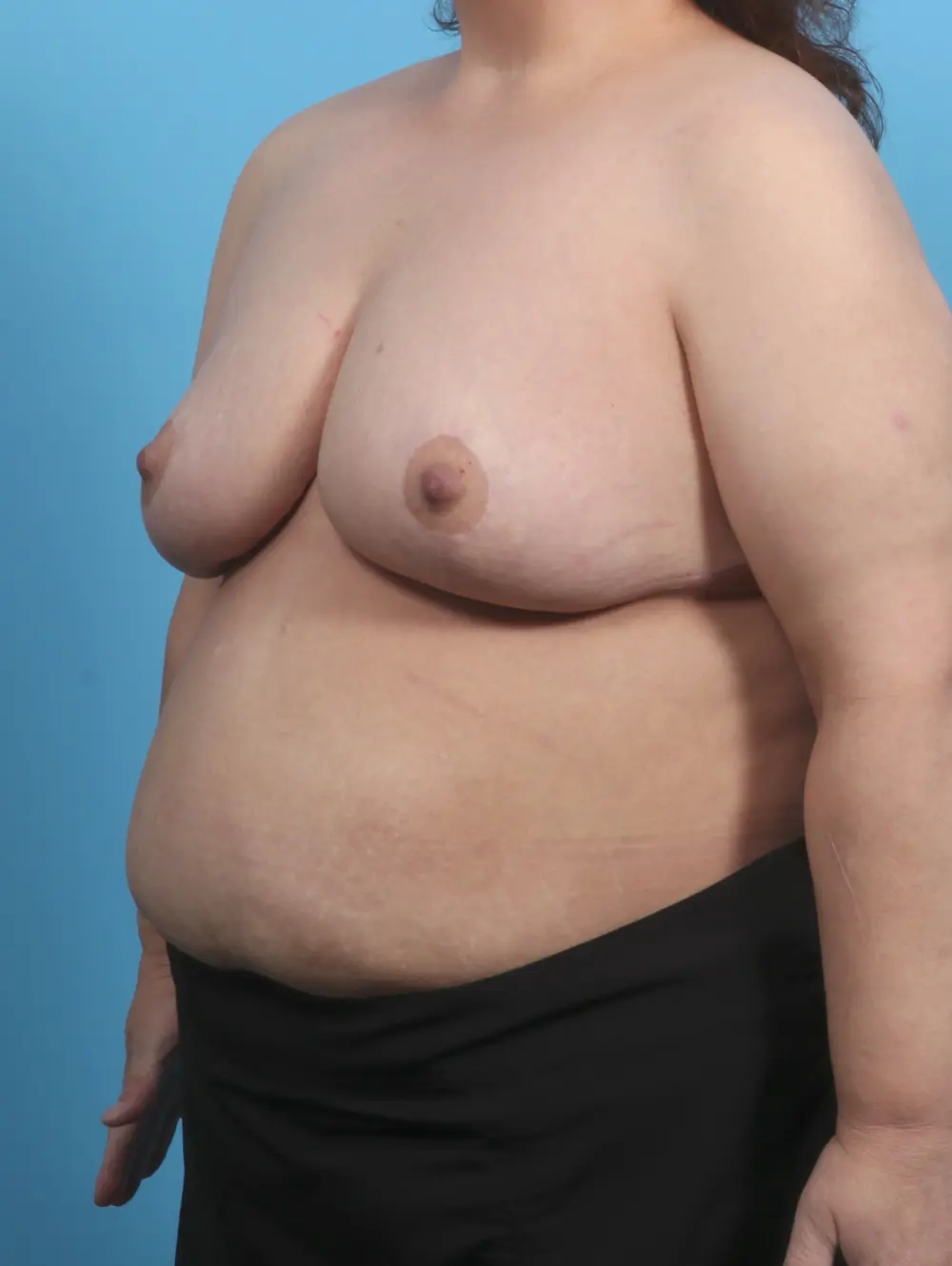 Breast Lift/Reduction w/o Implants Patient Photo - Case 29745 - after view-1