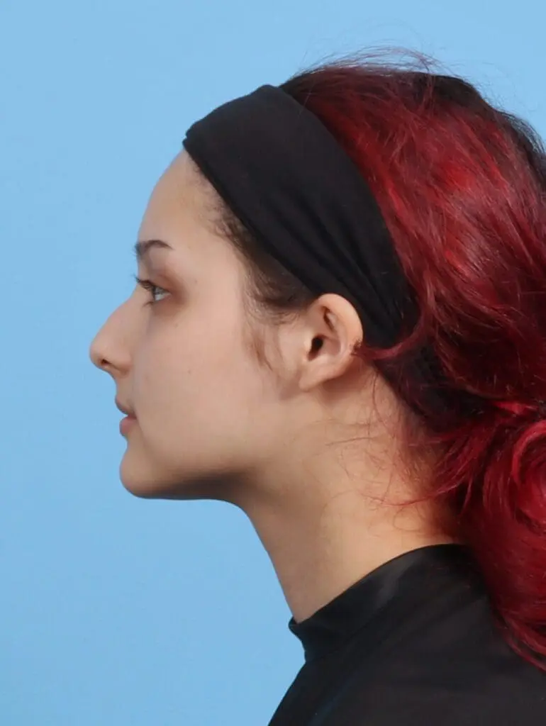 Rhinoplasty - Case 29761 - Before