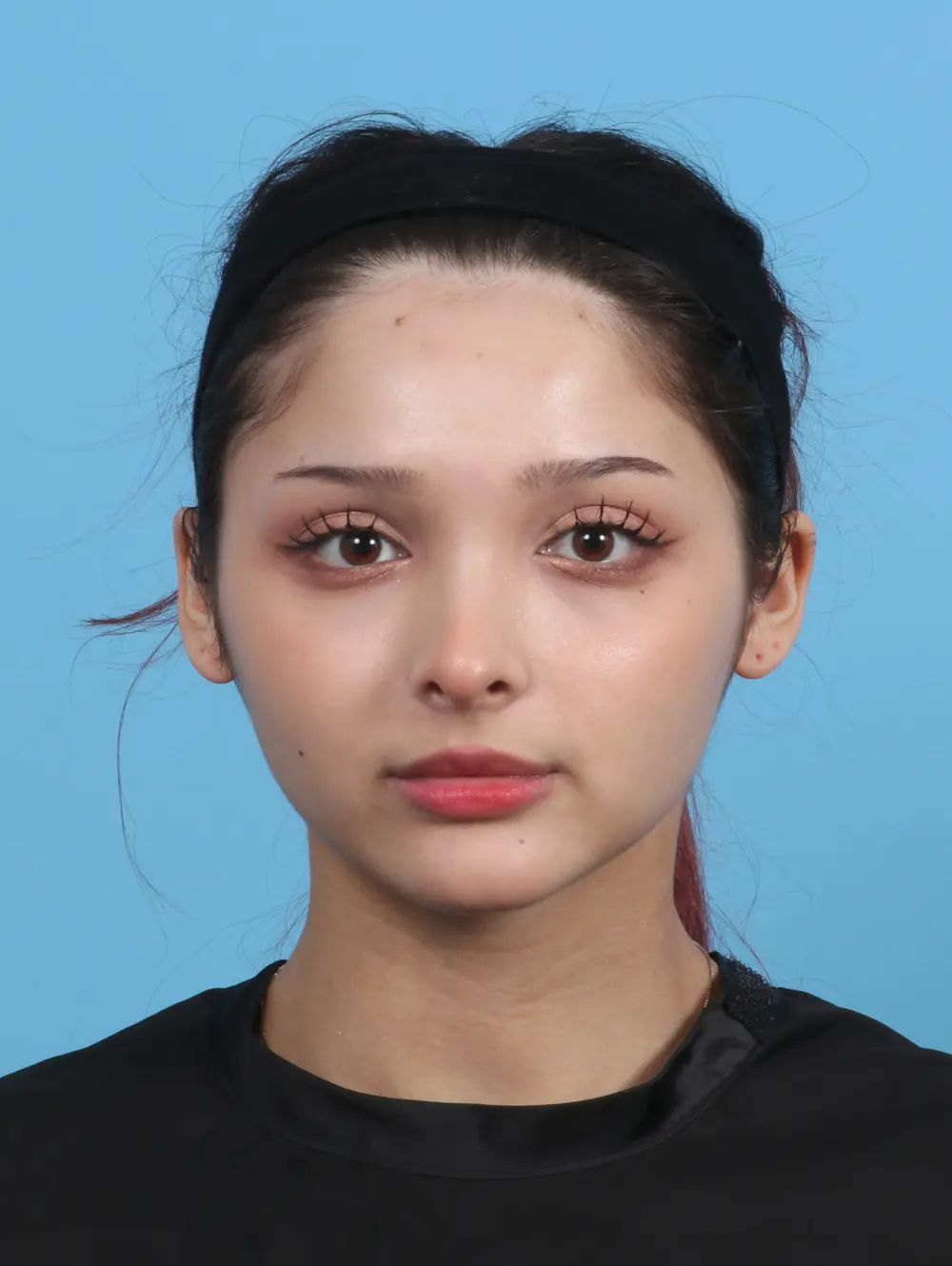 Rhinoplasty Patient Photo - Case 29761 - after view-2