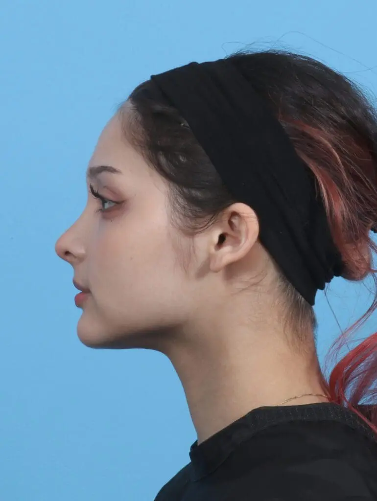 Rhinoplasty - Case 29761 - After