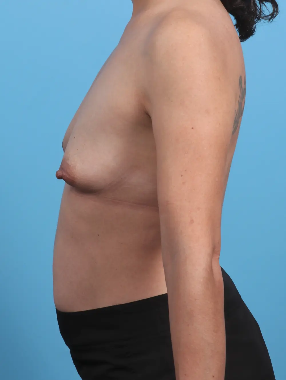 Breast Lift/Reduction with Implants Patient Photo - Case 29769 - before view-2