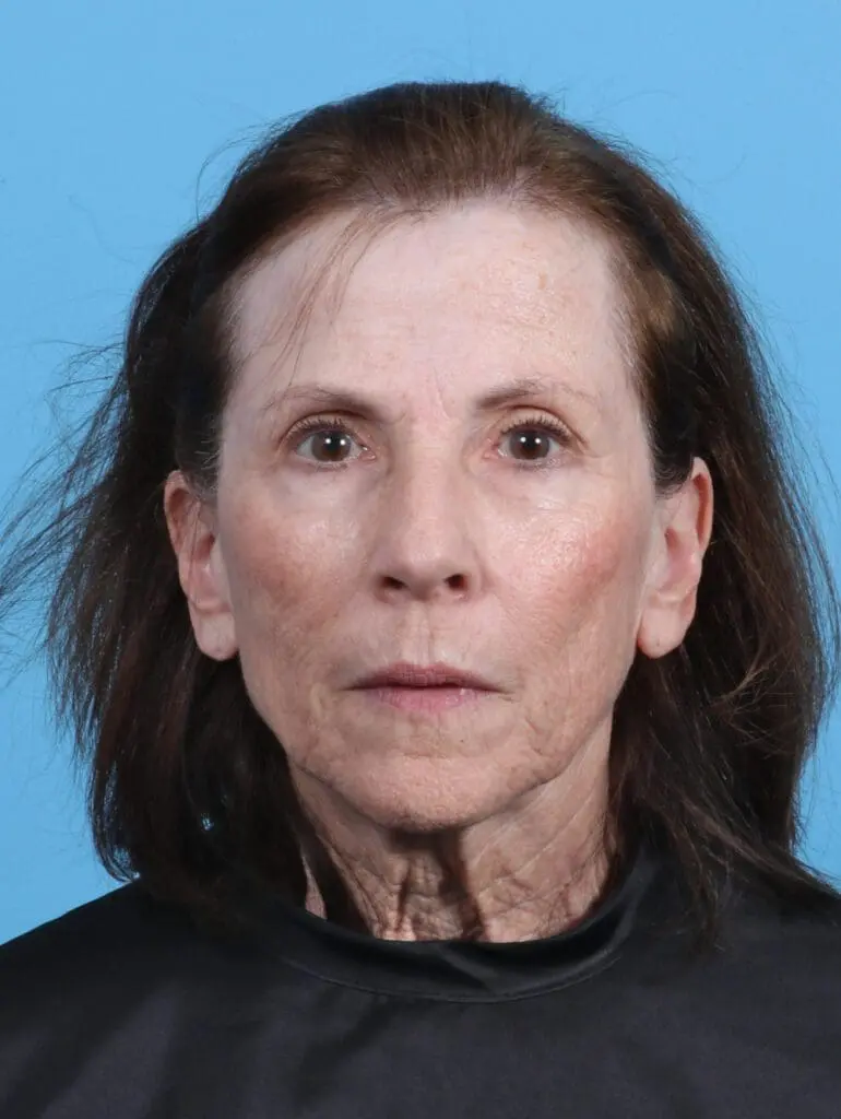 Eyelid Surgery - Case 29777 - Before