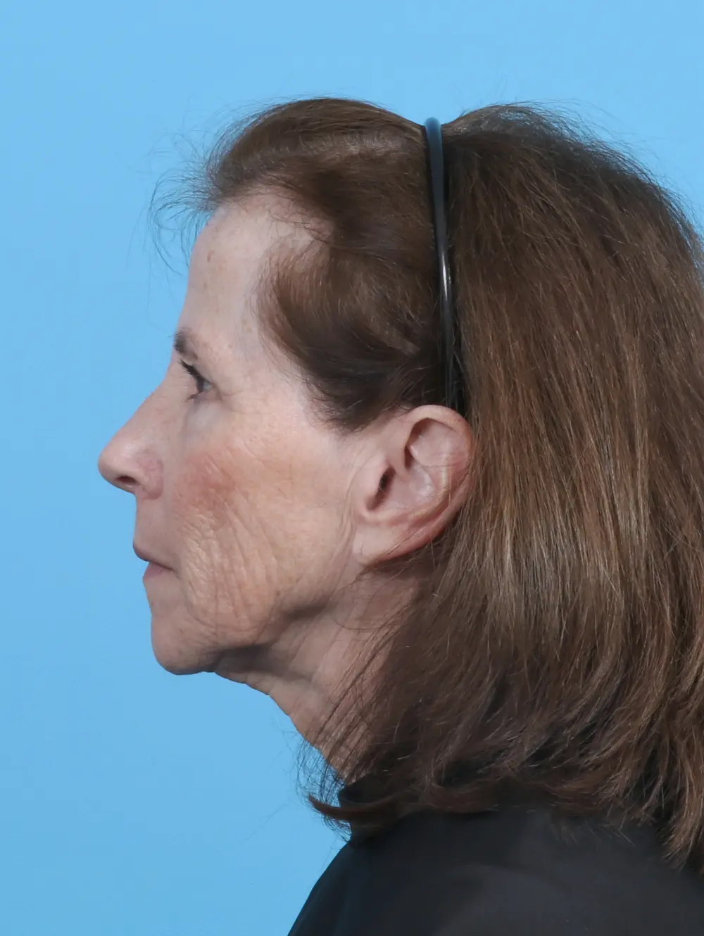 Eyelid Surgery Patient Photo - Case 29777 - before view-2