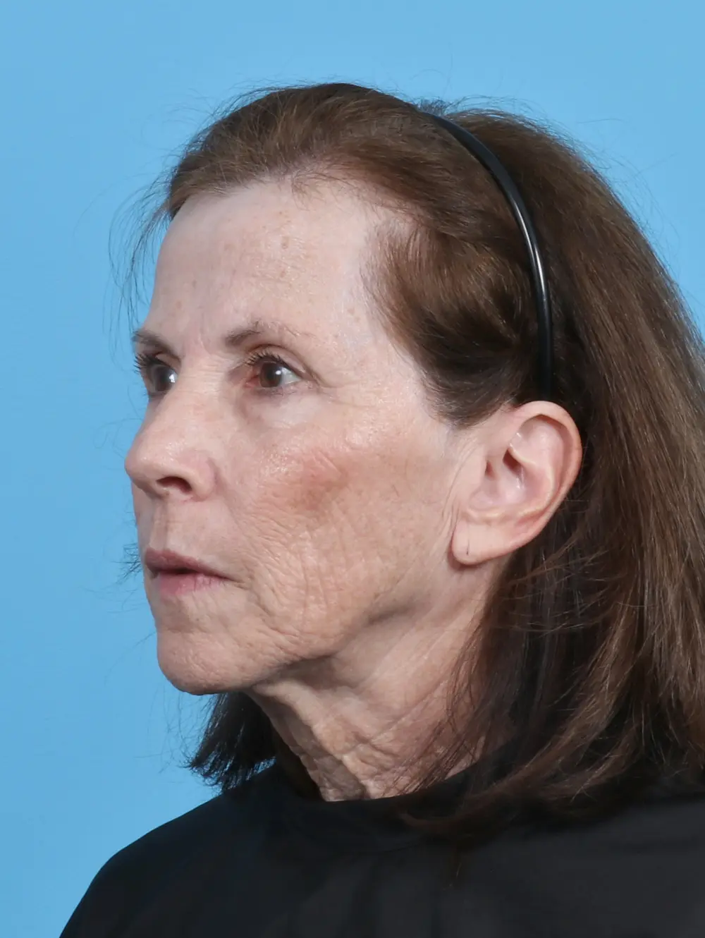 Eyelid Surgery Patient Photo - Case 29777 - before view-1