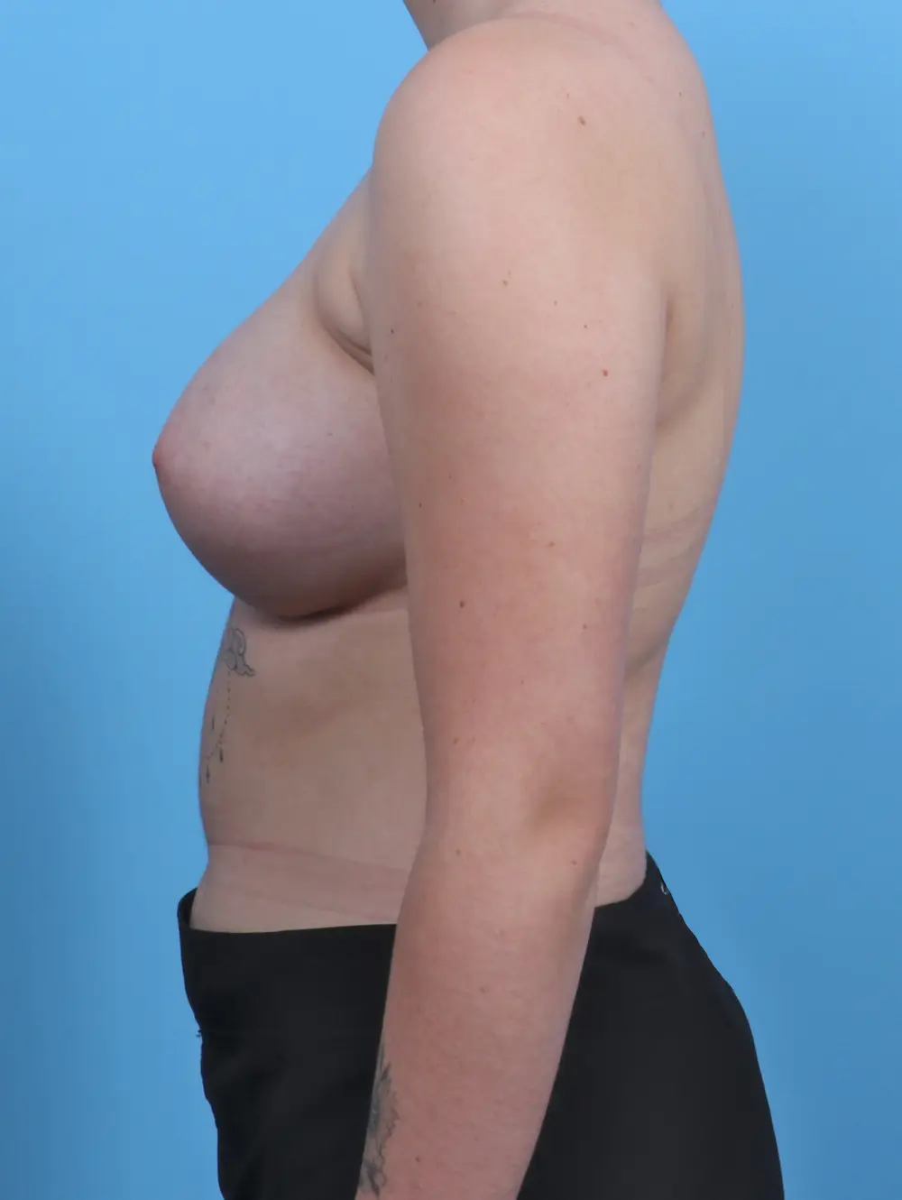 Breast Augmentation Patient Photo - Case 29785 - after view-2