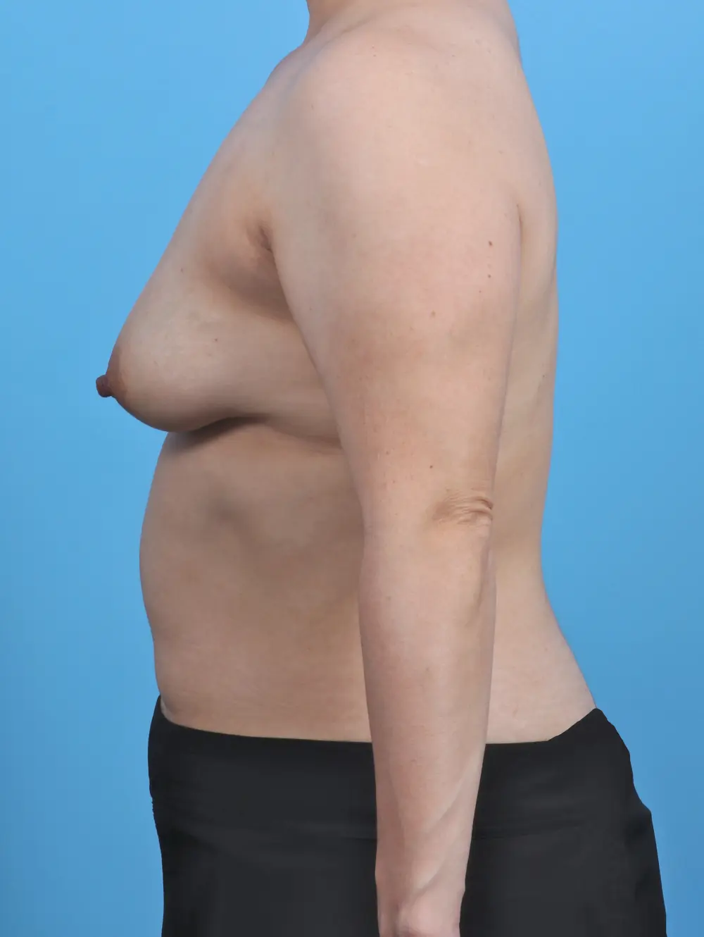 Breast Lift/Reduction with Implants Patient Photo - Case 29806 - before view-2