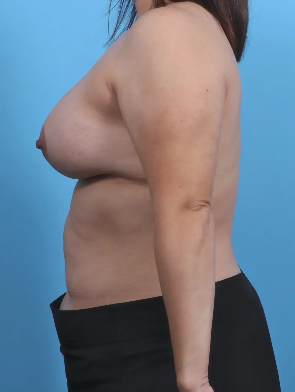 Breast Lift/Reduction with Implants Patient Photo - Case 29806 - after view-2