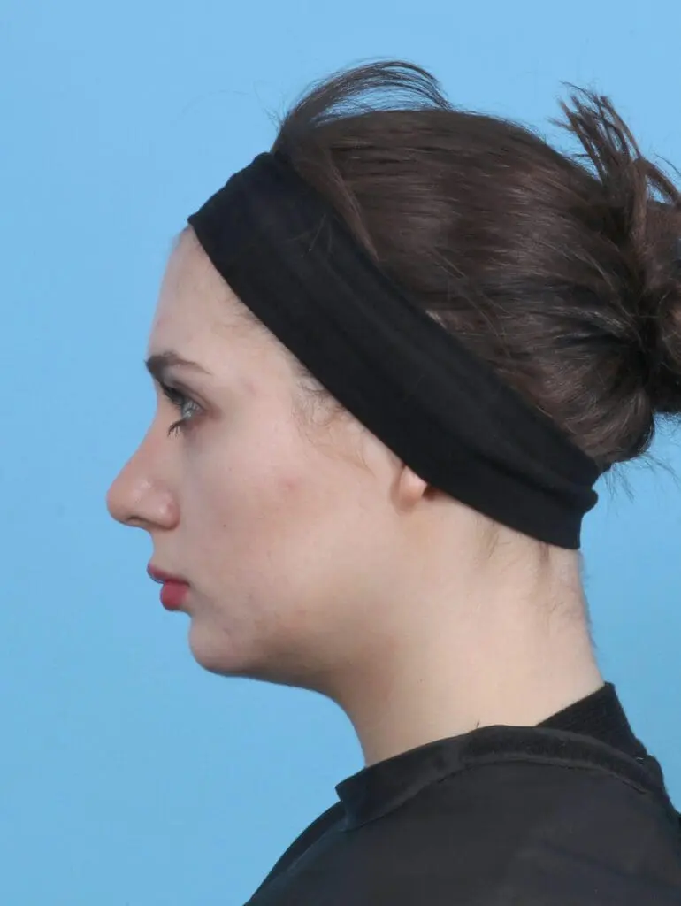 Rhinoplasty - Case 29830 - After