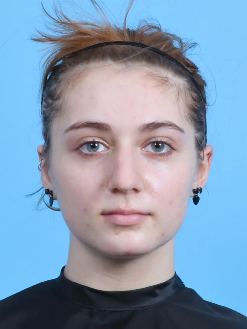 Rhinoplasty Patient Photo - Case 29830 - before view-2